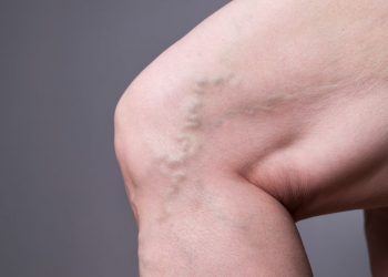 "סבלתי מכאבים ברגליים והברכיים – הטיפול של אורן זריף העלים לי אותם"