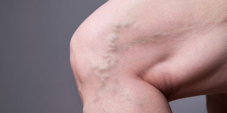 "סבלתי מכאבים ברגליים והברכיים – הטיפול של אורן זריף העלים לי אותם"